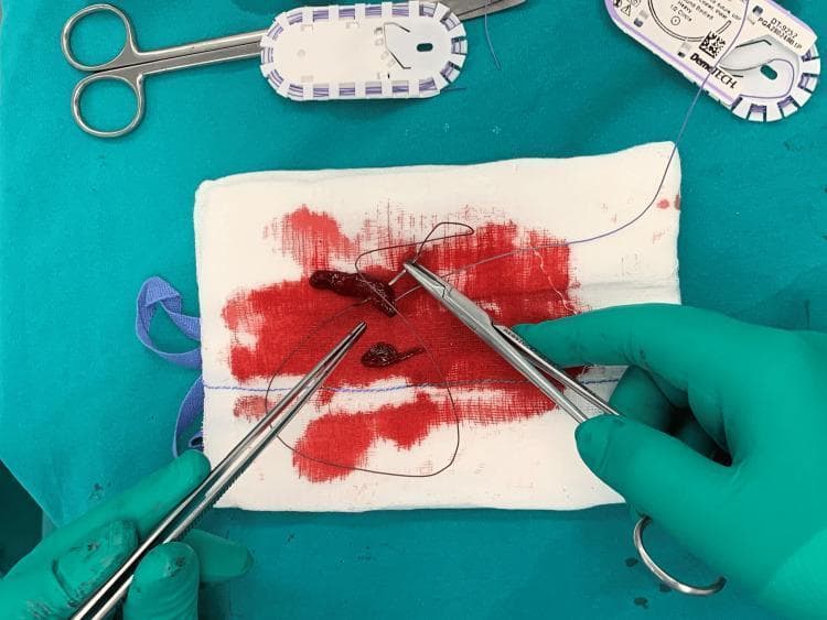 This clinical photograph illustrates a key step in an orthopedic surgical procedure, specifically the preparation of an autologous fibrin clot for meniscal repair. Centrally, two dark, gelatinous fibrin clots are positioned on a blood-stained sterile white sponge. A surgeon, wearing green sterile gloves, is using surgical forceps and a needle holder to thread fine, purple absorbable sutures through the ends of the fibrin clots. These sutures serve as traction or 'shuttling' lines to facilitate the precise intra-articular delivery of the clot into a meniscal gap during arthroscopy. The background consists of a green surgical drape, with additional surgical instruments, including scissors and suture packaging, visible. This technique is used in sports medicine to enhance the biological healing environment for meniscal tears by delivering concentrated growth factors directly to the avascular zones of the meniscus.