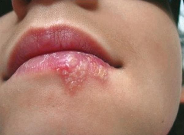 This clinical photograph shows a close-up of a patient's lower lip and perioral region, demonstrating a cluster of herpetic lesions consistent with Herpes Labialis (cold sores). The primary findings include a group of small, fluid-filled vesicles on an erythematous (reddened) base. These vesicles are concentrated on the vermilion border and extend onto the adjacent cutaneous surface of the lower lip. The vesicles exhibit varying degrees of opacity, with some appearing clear and others becoming cloudy as they progress. Mild perilesional inflammation (hyperemia) is visible. In contrast, the upper lip appears normal in color and texture with no active lesions. This image captures the vesicular stage of a recurrent herpes simplex virus (HSV-1) infection, illustrating typical morphology, including clustering, vesicle formation, and location at the mucocutaneous junction. It serves as an educational example for dermatological and oral pathology assessment, highlighting the physical signs used to diagnose and monitor the progression or healing of labial herpes.