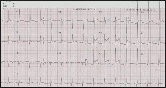 This diagnostic image is a standard surface 12-lead electrocardiogram (ECG) demonstrating several pathological findings. The primary abnormality is a diffuse ST-segment elevation with a concave or 'saddle-shaped' morphology, most prominent in the precordial leads V1-V5, as well as the high lateral leads I and aVL. Accompanying these changes is widespread PR-segment depression, particularly visible in the limb leads, which is a classic indicator of pericardial inflammation. In the inferior leads (II, III, and aVF), there is evidence of previous myocardial injury as indicated by the presence of pathological Q-waves and T-wave inversions. The baseline rhythm appears to be sinus. Clinically, these findings in combination—persistent ST elevation and PR depression following an initial ischemic event—are highly suggestive of Dressler syndrome or post-myocardial infarction pericarditis, often associated with a pericardial effusion. This ECG serves as an educational example for distinguishing between acute ST-segment elevation myocardial infarction (STEMI) and pericarditis in a post-surgical or post-procedural clinical setting.