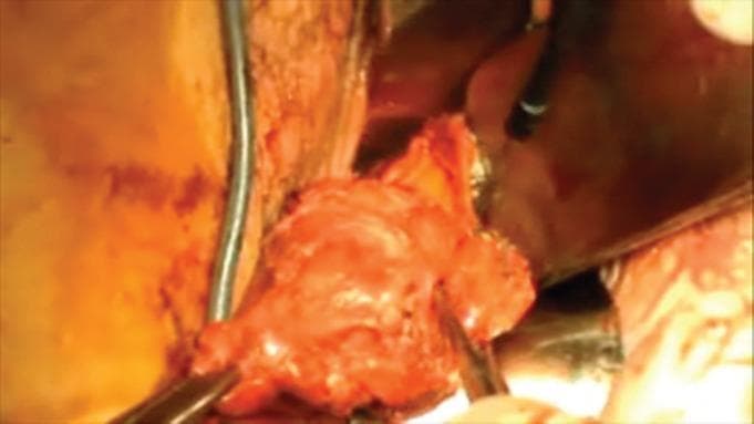 This clinical photograph captures an intraoperative view of a radical vaginal trachelectomy (RVT) for cervical cancer. The central focus is the surgical specimen, which consists of the cervix and attached parametrial tissue. The specimen is predominantly pinkish-red and fleshy, exhibiting a lobulated, irregular texture characteristic of vascularized uterine tissue. Visible surgical instruments, including a metal retractor and a grasping forceps or clamp, are positioned around and within the surgical field to provide exposure and stabilize the tissue for excision. The background shows the surrounding anatomical structures of the vaginal vault and pelvic cavity, which appear moist and hyperemic due to active surgical manipulation. This image illustrates a critical stage in fertility-sparing oncology surgery, emphasizing the resection margins required for treating early-stage cervical adenocarcinoma while preserving the uterine corpus.