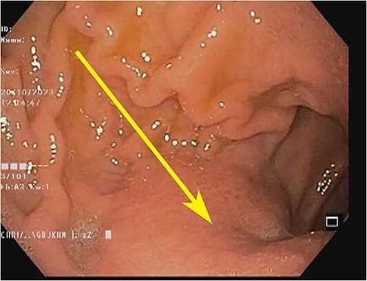 This endoscopic image displays the gastric antrum and distal stomach, highlighting key diagnostic features of linitis plastica. The mucosal surface shows a marked loss of rugosity, where the typical gastric folds are absent or flattened, resulting in a smooth and rigid appearance. There is widespread mucosal erythema, indicating inflammation. A yellow arrow points to an extramucosal bulge, suggesting a submucosal or infiltrating process. These findings are clinically significant as they represent diffuse infiltration of the gastric wall by signet-ring cell carcinoma, characterized by a lack of stomach expansion during insufflation. The image serves as a clinical example of the 'leather bottle' appearance of the stomach in advanced gastric malignancy, often associated with Krukenberg tumors in a systemic context.