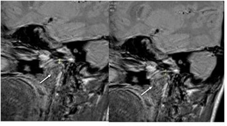 This diagnostic image consists of two sagittal MRI scans of the human temporomandibular joint (TMJ), comparing a baseline state (T0, left) with a follow-up state (T1, right) after functional appliance therapy. The scans clearly depict the mandibular condyle, the articular eminence of the temporal bone, and the intervening joint space. White arrows in both images highlight the condylar cartilage layer covering the superior-posterior aspect of the mandibular condyle. A comparison between T0 and T1 reveals a visible increase in the thickness and signal intensity of the condylar cartilage at T1. This finding serves as a clinical marker for orthopedic remodeling and growth stimulation of the cartilage following the use of a twin-block appliance in orthodontic treatment. The surrounding soft tissues, including the joint capsule and lateral pterygoid muscle attachments, are also visible, providing anatomical context for the assessment of functional jaw orthopedics.
