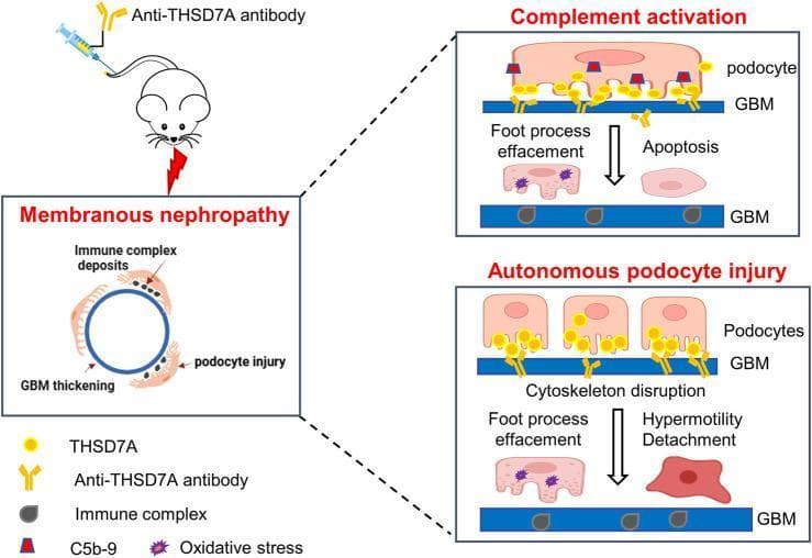 This pathophysiology diagram illustrates the dual pathomechanisms of THSD7A-associated Membranous Nephropathy (MN) based on a mouse model. The schematic shows a mouse being injected with anti-THSD7A antibodies, leading to MN characterized by subepithelial immune complex deposits, glomerular basement membrane (GBM) thickening, and podocyte injury. Two distinct pathways of injury are detailed: 1) Complement Activation: Anti-THSD7A antibodies (yellow) bind to THSD7A antigens on the podocyte surface, recruiting C5b-9 (red/blue markers) to form immune complexes. This leads to foot process effacement, oxidative stress, and podocyte apoptosis. 2) Autonomous Podocyte Injury: A complement-independent pathway where antibody binding directly causes cytoskeleton disruption. This results in foot process effacement, podocyte hypermotility, and eventual detachment from the GBM. The diagram serves as a model for primary MN, emphasizing both the immune-complex-mediated classical pathway and a direct, antibody-mediated cytotoxic effect that compromises the glomerular filtration barrier.