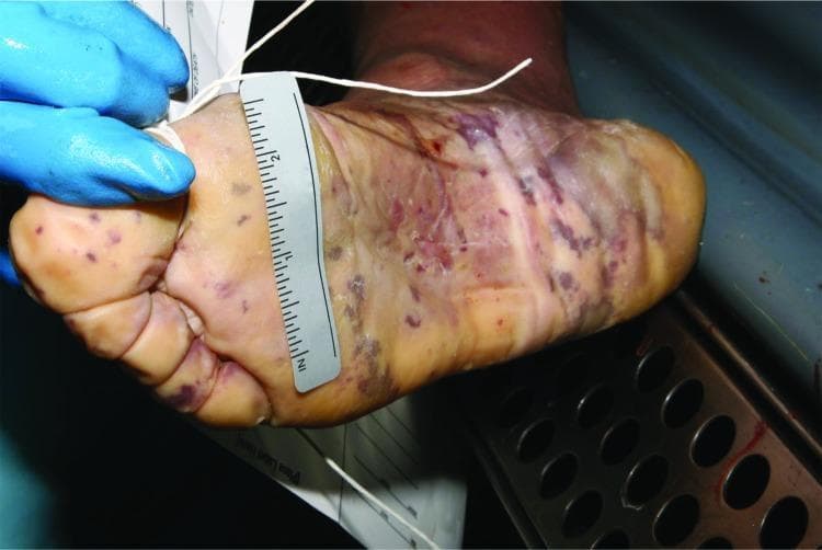 Clinical photograph of the plantar surface (sole) of a human foot during postmortem examination, demonstrating classic dermatological manifestations of invasive meningococcal disease. The image shows a widespread purpuric rash consisting of pinpoint petechiae and larger, confluent ecchymoses. These lesions are dark purple to blue-black in color and are most concentrated on the toes, heel, and lateral borders of the foot. Linear streaks of hemorrhage are visible across the arch. The surrounding skin exhibits postmortem changes, including pallor, mild maceration, and loss of turgor (wrinkling). A forensic ruler and identifying tags are present for scale and documentation. This visual serves as a critical educational example of fulminant meningococcemia (purpura fulminans) and its persistence in forensic pathology settings. The presentation highlights the importance of recognizing skin signs in the diagnosis of Neisseria meningitidis infection, even in cases of sudden death where clinical history may be absent.