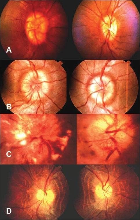 This clinical photograph panel displays four stages of papilledema (A–D) in fundus images, illustrating the progression of optic disc swelling due to increased intracranial pressure. Stage A (Early) shows optic disc hyperemia and mild blurring of the nasal margins with preserved retinal nerve fiber layer (RNFL) striations. Stage B (Established) demonstrates more pronounced circumferential disc elevation and obscuration of major retinal vessels crossing the margin, with increased vascular tortuosity. Stage C (Vintage/Chronic) highlights significant pathological changes including severe edema, cotton-wool spots, and retinal hemorrhages that further mask the disc anatomy. Stage D (Atrophic) shows the late-stage transition to optic atrophy, characterized by a pale, chalky-white optic disc with relatively defined margins compared to acute stages, accompanied by vessel attenuation and thinning of the RNFL. This comparison chart serves as an educational tool for ophthalmologists and neurologists to categorize the severity and duration of papilledema in clinical practice.