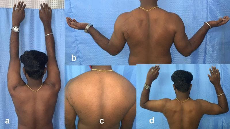 This composite of four clinical photographs (a-d) displays a posterior view of a patient’s upper back and shoulders during a postoperative orthopedic follow-up. The images assess the functional recovery of the shoulder following decompression of the suprascapular nerve.
Panel (a) demonstrates full active overhead abduction (approximately 180 degrees), showing symmetrical scapulohumeral rhythm. Panel (b) shows the patient with shoulders abducted to 90 degrees and in external rotation with elbows extended, highlighting a surgical scar on the left posterior shoulder. Panel (c) provides a neutral-position close-up of the back, demonstrating the restoration of muscle mass in the infraspinatus and supraspinatus fossae, indicating the resolution of previous neurogenic muscle wasting. Panel (d) shows active external rotation with the shoulders and elbows flexed at 90 degrees.
The collection illustrates a successful clinical outcome following the treatment of suprascapular nerve entrapment at the spinoglenoid notch, emphasizing the return of muscle bulk, symmetry, and full range of motion in the rotator cuff and deltoid groups.