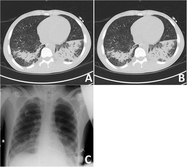 A multi-panel clinical imaging figure demonstrating severe lung pathology in a patient with Acute Respiratory Distress Syndrome (ARDS) secondary to autoimmune disease. Panels A and B are axial non-contrast CT scans of the chest at the level of the lower lobes, illustrating recruitment potential under varying Positive End-Expiratory Pressure (PEEP) levels. The lung parenchyma shows bilateral, heterogeneous inflammatory consolidations and ground-glass opacities, predominantly in the dependent (posterior) segments of the lower lobes. Panel C is a corresponding anteroposterior conventional chest radiograph (X-ray) showing bilateral basal opacities and increased density in the lower lung fields, consistent with the consolidations seen on CT. The images demonstrate the visual presentation of small airway disease and diffuse alveolar damage, characterized by airspace filling that obscures normal pulmonary markings. Clinical relevance includes the assessment of lung recruitment in critically ill patients and the radiographic manifestation of pulmonary hemorrhage or inflammation in systemic autoimmune conditions.