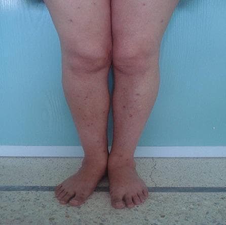 Clinical photograph of the lower extremities demonstrating multiple cutaneous lesions characteristic of systemic sarcoidosis. The image shows a symmetric distribution of red-to-violaceous papules and small nodules on the extensor surfaces of the shins and thighs. The lesions are well-circumscribed, vary in size, and some exhibit focal fine scaling on their surface. Clinically, these granulomatous skin lesions may display a 'lupoid' infiltrate appearance under diascopy (vitropression). The surrounding skin appears unremarkable without evidence of significant edema or ulceration. This visual presentation is an important dermatological manifestation of sarcoidosis, often correlating with multisystem involvement, including pulmonary and hepatic granulomatous disease as indicated by the patient's associated symptoms of dyspnea and elevated serum angiotensin-converting enzyme (ACE) levels.