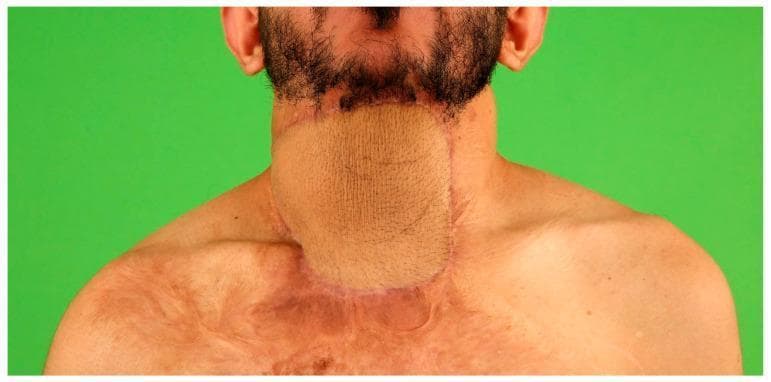 This clinical photograph shows a front-view of a patient's neck and upper torso one year after a secondary burn scar reconstruction. Centered on the anterior neck is a large, well-integrated pre-expanded Anterolateral Thigh (ALT) free flap used to release a sternomental contracture. The flap displays a uniform, slightly meshed texture and is paler than the surrounding skin, with clearly defined surgical margins and healed suture lines at its perimeter. Below and adjacent to the flap, the upper chest and right shoulder area exhibit significant post-burn sequelae, characterized by extensive mottled scarring, hypertrophic changes, and irregular patches of hyperpigmentation and hypopigmentation. The image illustrates the successful surgical management of complex burn-related neck contractures through microsurgical flap transfer, demonstrating improved range of motion and aesthetic outcome in reconstructive plastic surgery.