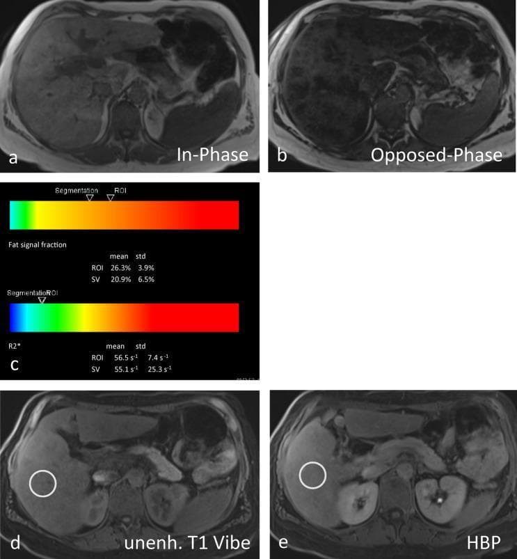 This composite of abdominal MRI scans and quantitative data illustrates advanced hepatic pathology, specifically nonalcoholic steatohepatitis (NASH). Panels (a) and (b) show T1-weighted In-Phase and Opposed-Phase images, demonstrating a significant drop in signal intensity across the liver parenchyma in the opposed-phase image, a hallmark of diffuse fatty infiltration (steatosis). Panel (c) provides quantitative 'LiverLab' analysis, indicating a proton density fat fraction (PDFF) of 26.3% (moderate-to-severe steatosis) and an effective R2* of 55.1 s⁻¹, ruling out significant iron overload. Panels (d) and (e) compare an unenhanced T1 Vibe sequence with a Hepatobiliary Phase (HBP) image following gadoxetic acid administration. The HBP image reveals a failure of the liver to enhance relative to the kidneys, signaling severely impaired hepatocyte uptake and advanced liver dysfunction consistent with fibrosis. This sequence of images serves as a clinical diagnostic tool for assessing chronic liver disease by combining morphologic fat quantification with functional hepatobiliary assessment.