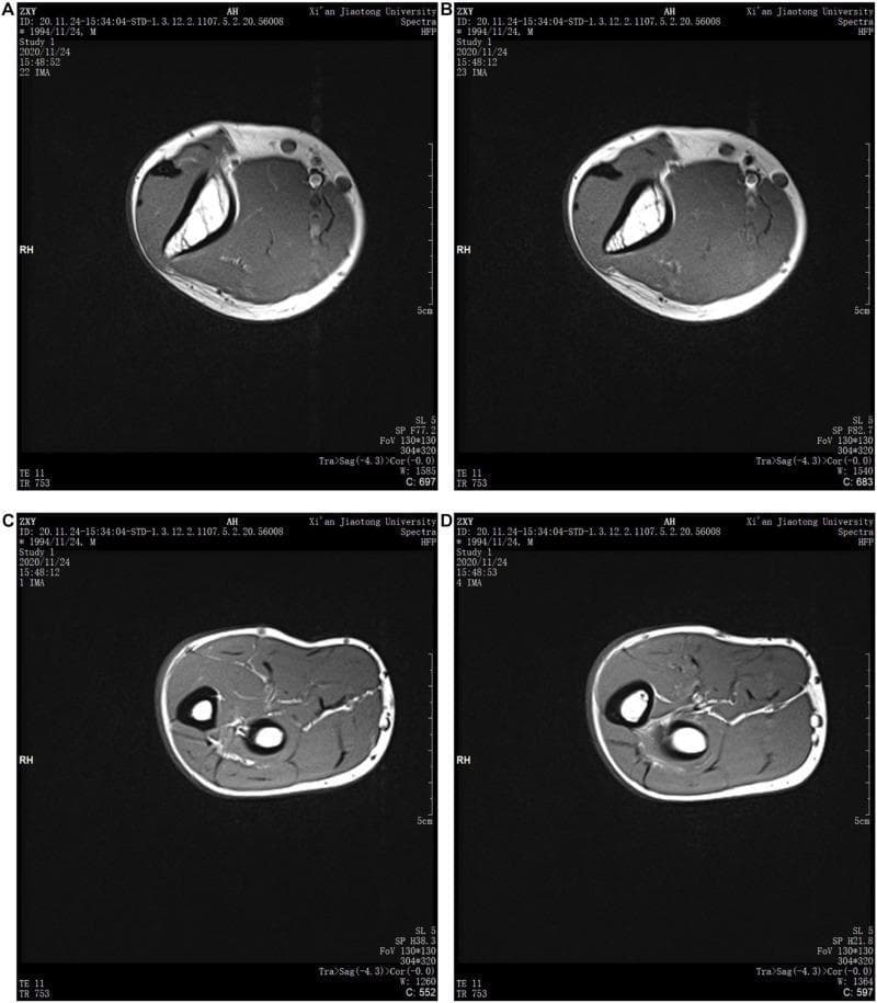 The image consists of four axial T1-weighted magnetic resonance imaging (MRI) cross-sections of the human upper limb, used for anatomical modeling. Panels A and B display cross-sections of the mid-upper arm, characterized by a single large central humerus (dark cortical bone with bright marrow signal) and expansive, encircling muscle groups. Panels C and D show the mid-forearm, clearly distinguished by the presence of two distinct bones: the radius and the ulna. Across all images, there is a clear demarcation of tissue layers including the outermost skin, a bright subcutaneous adipose layer, dark skeletal muscle compartments, and vascular structures. The contrast between the high-signal fat and intermediate-signal muscle allows for the identification of intermuscular septa and neurovascular bundles. These diagnostic images provide the anatomical foundation for understanding musculoskeletal structure, fluid distribution (relevant to lymphedema studies), and the spatial relationship between cortical bone and surrounding soft tissue compartments in the extremities.