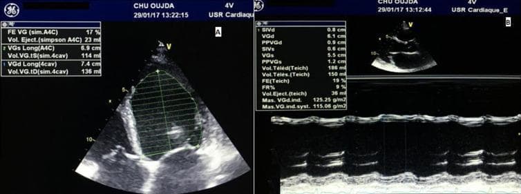 Transthoracic echocardiogram (TTE) in a patient with dilated cardiomyopathy, presented in two panels. Panel A displays a 2D apical 4-chamber view during systole. The Simpson's biplane method is applied to the dilated left ventricle, showing severe global hypokinesia with a measured ejection fraction (LVEF) of 17% and an end-systolic volume (ESV) of 114 ml. Panel B shows a parasternal long-axis view with M-mode tracing across the left ventricle. Quantitative analysis indicates a dilated left ventricular end-diastolic diameter (LVEDD) of 6.1 cm (61 mm) and significantly reduced wall motion, with a Teichholz-calculated ejection fraction of 19% and a fractional shortening of 9%. The interventricular septum and posterior wall thicknesses are relatively thin (0.8 cm and 0.9 cm respectively), consistent with eccentric remodeling. These findings demonstrate severe systolic dysfunction and ventricular dilatation, characteristic of peripartum cardiomyopathy as described in the clinical context.