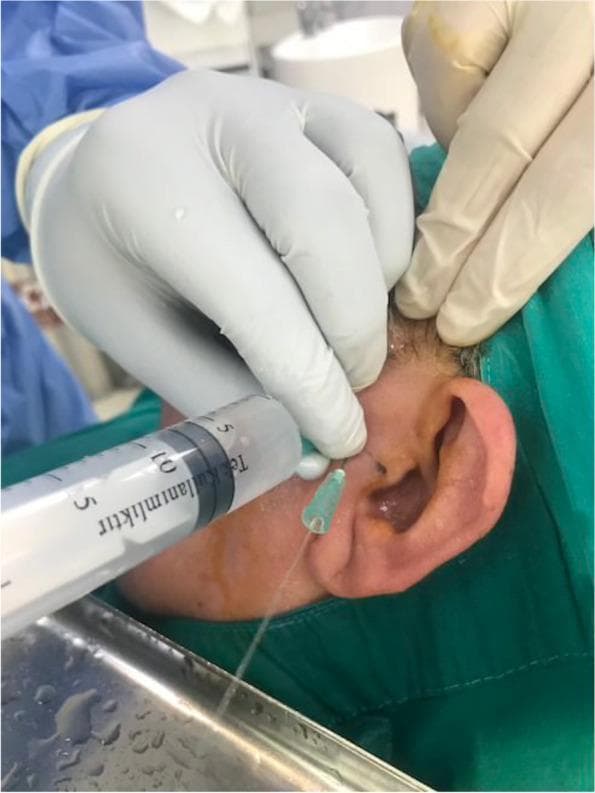 A close-up clinical photograph showing an arthrocentesis procedure of the temporomandibular joint (TMJ). A clinician wearing sterile surgical gloves is performing a needle aspiration or irrigation at the preauricular region. A large-bore syringe is connected to a needle inserted into the superior joint space, approximately 10 mm anterior to the tragus and 2 mm below the Holmlund-Hellsing line. A secondary egress needle is visible, with clear irrigation fluid (likely Ringer’s lactate) flowing out of the joint and draining into a sterile surgical tray positioned below the patient's face. The patient is draped in a green sterile field, and the skin appears prepared for a sterile procedure. This image illustrates a common minimally invasive surgical treatment for TMJ internal derangement, aimed at lysing adhesions and removing inflammatory mediators from the joint space.