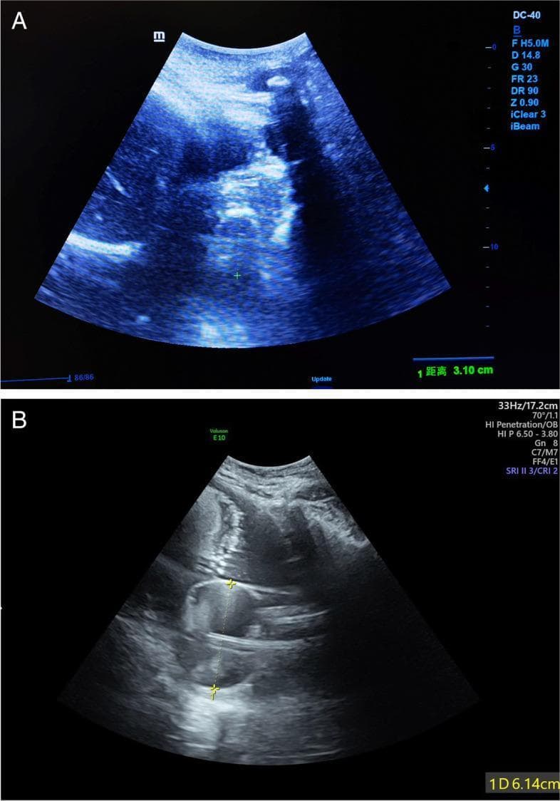 Two sagittal pelvic ultrasound images demonstrate a Cook Cervical Ripening Balloon (CCRB) positioned within the lower uterine segment of a pregnant woman. Image A (Control Group) shows a roughly spherical, fluid-filled balloon with a measured diameter of 3.10 cm, corresponding to a standard 80 mL fill volume. The internal echogenicity is heterogeneous with somewhat irregular borders. Image B (Study Group) depicts the balloon after increasing the volume to approximately 120 mL, resulting in an elongated, larger structure with a measured diameter of 6.14 cm. In both images, the relationship between the mechanical balloon and the adjacent fetal presenting part is visible, illustrating how the device exerts pressure on the internal cervical os to promote cervical ripening and mechanical dilation. These images serve as educational materials for obstetric induction of labor protocols, specifically comparing traditional versus high-volume balloon dilation techniques to improve Bishop scores and successful vaginal delivery rates.