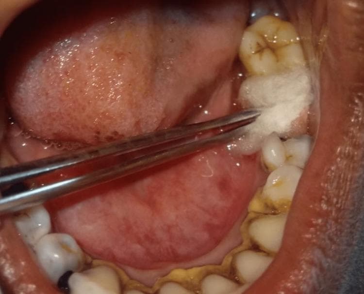 This intraoral clinical photograph captures a post-operative dental procedure within the oral cavity. A pair of metallic surgical forceps is used to apply a saturated white cotton swab directly to a fresh extraction site in the mandibular posterior region. The surrounding dentition displays generalized yellowish-brown extrinsic staining and calculus accumulation, particularly along the cervical margins. Occlusal surfaces of the visible molars show characteristic anatomical fissures with minor staining. The surrounding soft tissues, including the lateral border of the tongue and buccal mucosa, appear physiologically normal. This image illustrates a localized clinical interventionโthe application of ozonized olive oilโintended for wound management and pain reduction following simple exodontia. It serves as an educational example of post-extraction site care and the clinical application of topical therapeutic agents in oral surgery.