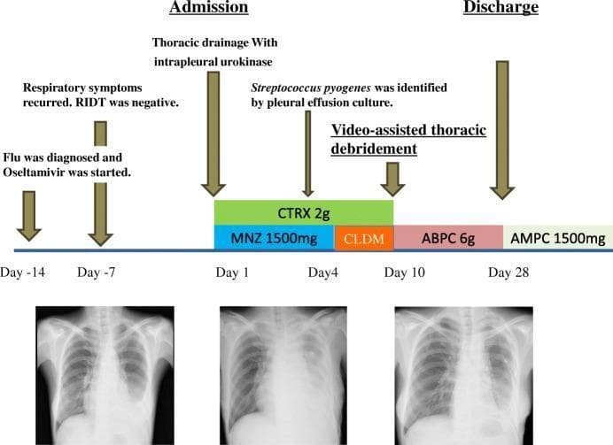 This medical infographic combines a clinical timeline with serial diagnostic imaging to illustrate the management of acute empyema secondary to Streptococcus pyogenes infection. The upper section features a timeline spanning from Day -14 to Day 28, detailing clinical events such as initial influenza diagnosis, recurrence of respiratory symptoms, and admission interventions. It outlines a treatment algorithm including thoracic drainage with intrapleural urokinase, antibiotic therapy (Ceftriaxone, Metronidazole, Clindamycin, Ampicillin, and Amoxicillin), and video-assisted thoracic debridement on Day 10. The lower section contains three sequential posterior-anterior (PA) chest X-rays. The initial X-ray shows a large left-sided pleural effusion with significant basal opacity and blunting of the costophrenic angle. Subsequent films demonstrate the clinical progression and resolution of the effusion following drainage and surgery, characterized by increasing aeration of the left lung field, reduction in opacity, and return of visible pulmonary vascular markings, reflecting successful therapeutic intervention and lung expansion.