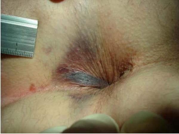 This clinical photograph displays a close-up view of the perianal region, documenting acute tissue trauma. The image shows extensive ecchymosis and subcutaneous hematomas surrounding the anal orifice. The discoloration is multifocal, ranging from deep purple and blue at the anal verge to reddish-purple and brown at the periphery of the affected area. Significant edema is present, resulting in the swelling and distortion of the perianal skin folds. A metal ruler with a metric scale is positioned in the upper left quadrant of the frame for size reference. The visual findings demonstrate an induced subcutaneous hematoma, which serves as a clinical comparison to differentiate mechanical trauma from thrombosed external hemorrhoids (TEH). This material is relevant for proctology and forensic medicine, illustrating the morphology of perianal ecchymosis and the physical manifestations of localized suction or pressure-induced injury to the subcutaneous venous plexus.