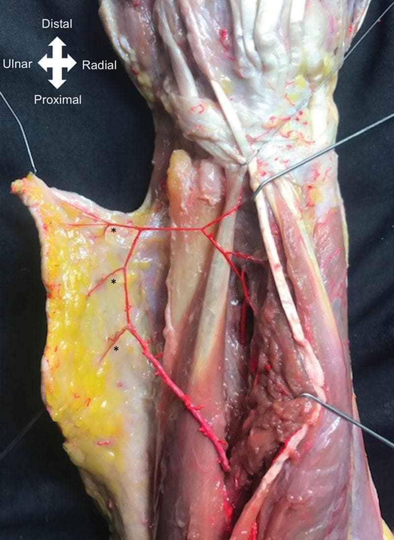 Anatomical dissection of a human cadaver forearm, focusing on the distal third of the posterior compartment. The image demonstrates the surgical anatomy relevant for raising a posterior interosseous artery (PIA) flap. The dissection reveals the Extensor Carpi Ulnaris (ECU) and Extensor Digiti Minimi (EDM) muscles, with a retracted skin and fasciocutaneous paddle reflected ulnarly. Key features include three distinct fasciocutaneous perforators of the PIA, marked with asterisks, emerging through the intermuscular septum between the EDM and ECU. These vessels are highlighted in red to show their branching pattern as they supply the overlying subcutaneous tissue and skin. Directional markers indicate Distal, Proximal, Ulnar, and Radial orientations. This visual is intended for educational purposes regarding reconstructive surgery, specifically illustrating the vascular landmarks and pivot points required for antegrade or retrograde forearm flaps used in hand or elbow defect coverage.