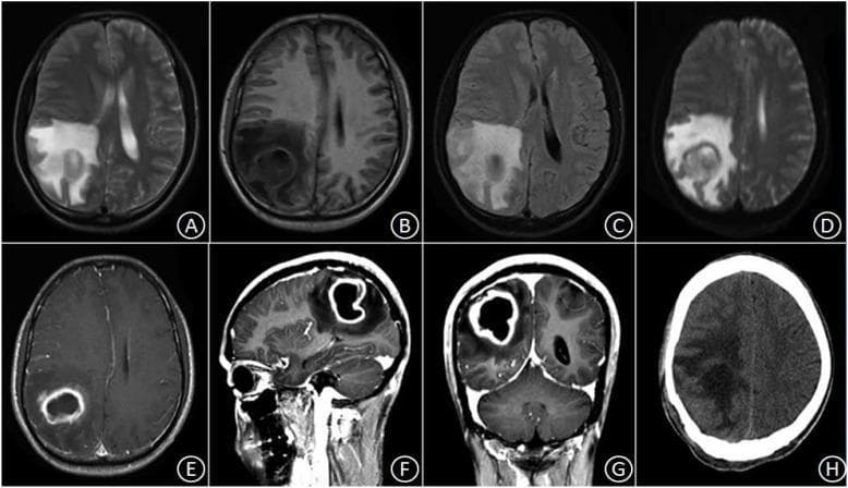 This composite figure displays diagnostic imaging of a brain abscess in the right parietal lobe, showing its evolution from pre-operative MRI to post-operative CT. Images A–G represent multi-modal MRI sequences: axial T2-weighted (A), axial T1-weighted (B), and FLAIR (C) scans reveal an irregularly circular lesion with central fluid signals and extensive surrounding vasogenic edema. The diffusion-weighted imaging (DWI) shows characteristic restricted diffusion within the abscess cavity. Contrast-enhanced MRI in axial (E), sagittal (F), and coronal (G) planes demonstrates classic peripheral ring enhancement with a smooth, relatively even wall thickness, typical of a pyogenic abscess. The lesion causes local mass effect, compressing the adjacent right lateral ventricle and shifting midline structures to the left. Frame H is a post-operative non-contrast axial CT scan taken three weeks after surgical excision, showing the complete disappearance of the ring-enhancing lesion and a reduction in mass effect, although residual low-density patches of edema with blurred boundaries remain in the right parietal region. This series illustrates the diagnostic hallmarks of a cerebral abscess and the expected radiological progression following neurosurgical intervention.