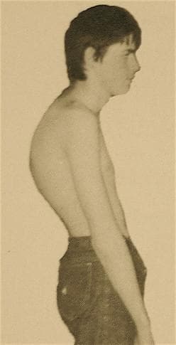 This clinical photograph provides a lateral view of a male patient demonstrating severe sagittal plane spinal deformity characteristic of Scheuermann's disease (juvenile kyphosis). The image illustrates a pronounced, fixed angular thoracic kyphosis centered in the mid-to-upper back. Visible compensatory mechanisms include an exaggerated lumbar lordosis (increased inward curvature of the lower spine) and increased cervical lordosis. The patient's posture is marked by a forward head protrusion, often referred to as 'gooseneck' posture, where the head is positioned anterior to the vertical axis of the shoulders. The shoulders themselves appear rounded and anteriorly displaced. This visual representation serves as an educational example of significant spinal imbalance and the characteristic morphological changes associated with structural hyperkyphosis in the thoracic region. This content is relevant for orthopedic and physical therapy studies focusing on spinal pathology, postural assessment, and sagittal alignment disorders.