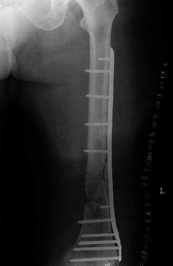 This anteroposterior (AP) view X-ray radiography of the left femur demonstrates internal fixation of a distal femoral fracture or nonunion. A long titanium locking compression plate (LCP) is positioned along the lateral aspect of the femoral shaft, extending from the proximal diaphysis to the distal metaphysis. The plate is secured with multiple radiopaque locking screws: five screws are visible in the proximal segment and five in the distal segment, bridging the fracture site. At the mid-to-distal transition of the femur, the fracture site exhibits signs of debridement with irregular bone margins and localized radiolucency, indicative of a bone defect or nonunion. This area is packed with autologous cancellous bone graft, visible as a cluster of mottled radiodense material within the surgical gap. The hardware appears intact, and the anatomical alignment of the femur is maintained. This image is clinically relevant for orthopaedic studies focusing on the management of complex femoral nonunions, bone grafting techniques, and the use of locking plate osteosynthesis.