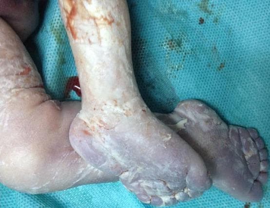 Clinical photograph of a fetus's lower limbs and feet, demonstrating multiple congenital malformations. The feet show severe bilateral talipes equinovarus (clubfoot), characterized by inward and downward rotation with excessive plantar flexion. Postaxial polydactyly is evident on at least one foot, which presents with six digits. The skin appears pale to cyanotic (bluish tint) with evidence of desquamation and epidermal sloughing, potentially indicating post-mortem changes or intrauterine distress. Traces of blood and vernix caseosa are visible on the skin surface. These findings are consistent with polymalformative conditions, such as Meckel-Gruber syndrome, which often involves multisystem congenital defects including limb and digit abnormalities. The photograph serves as an educational example of macroscopic fetal pathology for pediatrics, genetics, and obstetrics.