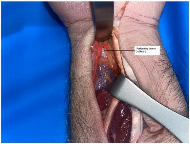 A clinical photograph of a surgical cadaveric dissection of the distal forearm and wrist region. The image utilizes a color overlay to highlight vascular anatomy. The primary focus is the radial artery, shown in bright red, along with a highlighted 'perforating branch (radial a.)' extending toward the deeper musculature. Metal surgical retractors are used to expose the deeper anatomical compartment, revealing the underlying muscles, tendons, and connective tissue. The dissection follows a modified Henry approach to expose the pronator quadratus (PQ) muscle. The photograph demonstrates the anatomical relationship between the radial artery's distal perforators and the surrounding forearm structures, serving as an educational resource for plastic and reconstructive surgery, specifically for designing pedicled muscle flaps for opponensplasty.