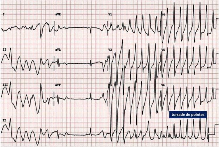 This diagnostic image is a 12-lead electrocardiogram (ECG) strip demonstrating a polymorphic ventricular tachycardia known as Torsades de Pointes (TdP). The tracing shows wide-complex tachycardia characterized by a cyclical variation in the QRS amplitude and axis, giving the classic appearance of the complexes 'twisting' around the isoelectric baseline. The rhythm is highly irregular with no discernible P waves. In the precordial leads (specifically V4, V5, and V6), the morphology exhibits rapid, spindle-shaped oscillations where the peaks of the QRS complexes shift direction. The onset is preceded by a 'short-long-short' RR interval sequence, a common trigger for this arrhythmia. This clinical finding is critical for cardiology and emergency medicine, often associated with a prolonged QT interval and potentially leading to ventricular fibrillation. The ECG is presented on standard grid paper for the evaluation of cardiac rate, rhythm, and interval measurements.