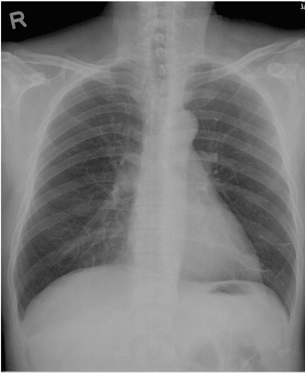 This diagnostic image is a posterior-anterior (PA) view chest X-ray. It displays a solitary pulmonary nodule or mass shadow located in the left lower lung field. The mass is radiopaque (appearing white relative to the darker, air-filled lung parenchyma) and exhibits somewhat ill-defined borders, partially overlapping the cardiac silhouette and the left hemidiaphragm. Primary anatomical landmarks visible include the rib cage, clavicles, vertebral column, and the heart, providing context for the mass's position within the lower lobe region. The mediastinum appears midline, and the trachea is patent. In clinical context, such a finding may represent primary pulmonary adenocarcinoma or metastatic disease. The image is an essential educational tool for medical training in radiology and pulmonology, demonstrating the visual presentation of a peripheral lung mass and the importance of correlating radiographic findings with clinical history and follow-up computed tomography (CT).