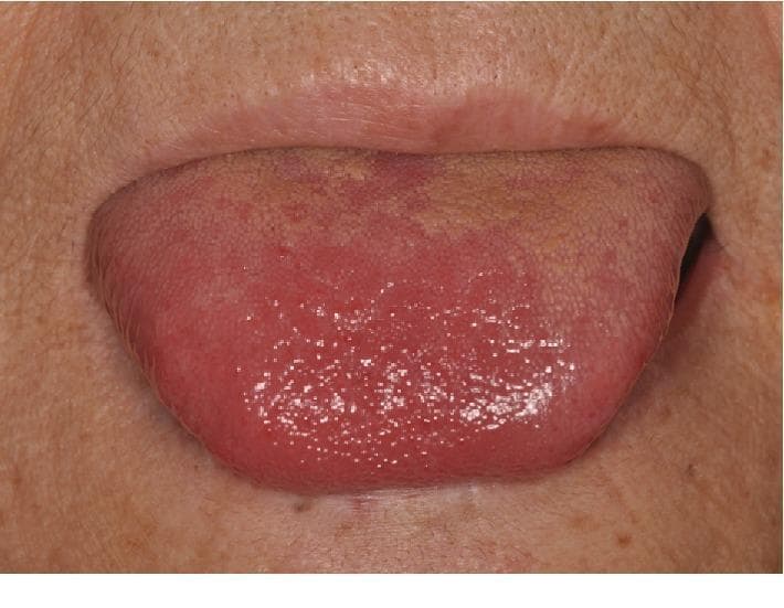This clinical photograph shows a close-up, frontal view of a human tongue protruded from the oral cavity. The primary finding is focal erythema (redness) and inflammation at the apex (tip) and anterior dorsal surface of the tongue. The affected area appears moist, glossy, and more intensely red compared to the more posterior regions. There is evidence of filiform papillae atrophy in the erythematous zone, giving it a smoother appearance, while the posterior dorsal surface exhibits a yellowish-tan coating or slight discoloration. The surrounding perioral skin appears unremarkable. This visual evidence of glossitis and dysgeusia in a febrile patient with elevated inflammatory markers (CRP and WBC) is clinically significant in evaluating systemic infections or inflammatory conditions, such as infective endocarditis (IE) following dental procedures. The image serves as an educational example of oral manifestations of systemic disease and localized glossal inflammation.