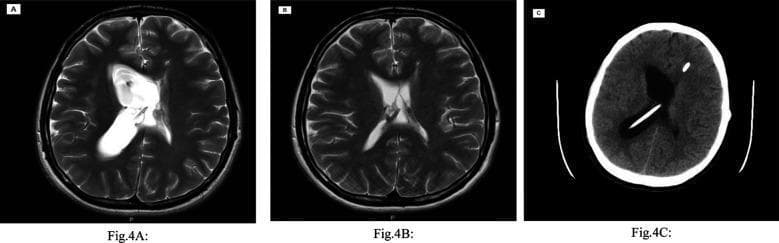 This composite figure includes radiological imaging of the brain in the axial plane, illustrating the evolution of hydrocephalus associated with ventriculoperitoneal shunt (VPS) malfunction. Panels A and B are T2-weighted MRI scans. Image A shows a significantly dilated, entrapped right lateral ventricle exhibiting a bright, hyperintense signal characteristic of cerebrospinal fluid accumulation due to right-sided shunt failure. Image B shows the same patient shortly after, displaying a reduction in ventricular volume and normalized morphology, indicating a temporary improvement in hydrocephalus. Panel C is a non-contrast axial CT scan showing a recurrence of hydrocephalus. A high-density (bright) linear structure is visible traversing the right cerebral parenchyma and terminating in the enlarged right lateral ventricle, representing the radio-opaque proximal shunt catheter. A separate circular hyperdensity within the calvarium denotes a shunt component or connector. This series highlights the diagnostic utility of MRI and CT in monitoring shunt-dependent hydrocephalus and identifying complications like entrapped ventricles.
