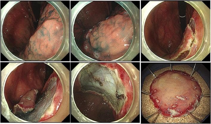 This composite of clinical endoscopic images demonstrates a step-by-step endoscopic submucosal dissection (ESD) for a gastric dysplasia lesion. The initial frames show the identification of the target lesion, where 0.1% indigo carmine dye has been applied to delineate the margins and surface morphology. The subsequent frames illustrate the active dissection phase: a circumferential mucosal incision is performed using an IT knife (electrosurgical generator), followed by the dissection of the submucosal layer to separate the lesion from the underlying muscularis propria. The visualization shows the 'lifting' of the mucosal layer away from the deeper gastric wall, exposing a clean, white submucosal base. The final frame depicts the pathological specimen after en bloc resection, pinned out on a dark board with surgical pins to maintain its orientation and size for histological examination. This procedure is critical in managing high-grade dysplasia (HGD) or early gastric cancer, allowing for complete removal with lower local recurrence rates compared to piecemeal resection techniques.