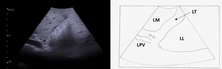 This composite image consists of an intraoperative ultrasound (IOUS) of the liver (left) and a corresponding anatomical line diagram (right) illustrating segmental liver anatomy and vascular landmarks. The ultrasound displays the ligamentum teres (LT) as a distinct, hyperechoic (bright) linear zone located at the free edge of the falciform ligament. This ligament serves as a key surgical landmark, separating the left medial (LM) segment (Segment 4b) from the left lateral (LL) segment (Segment 3). The umbilical portion of the left portal vein (LPV) is visualized as an anechoic (black) tubular structure terminating at the level of the ligamentum teres. The LPV is shown giving off its terminal segmental branches to supply segments 3 and 4b. The educational focus is on the use of IOUS for precise intrahepatic anatomical localization, identification of the Couinaud segments, and tracking the portal venous pedicles during hepatobiliary surgery.