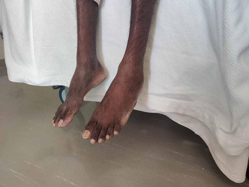 Clinical photograph of a patient in a seated position with both legs dangling, demonstrating classic bilateral foot drop. The image shows prominent plantarflexion of the ankles with an inability to maintain a neutral or dorsiflexed position, a finding characteristic of bilateral peroneal nerve palsy or peripheral neuropathy. Generalized muscle wasting is evident in the lower limbs, consistent with cachexia. Digital examination reveals clubbing of the toes and thickened, discolored toenails. This visual presentation correlates with a high steppage gait and is seen in various systemic conditions, including nutritional deficiencies (Vitamin B12), chronic infections such as miliary tuberculosis, or advanced metabolic disorders. The photograph provides a clear educational example of neurological deficits manifested in physical examination and musculoskeletal positioning.