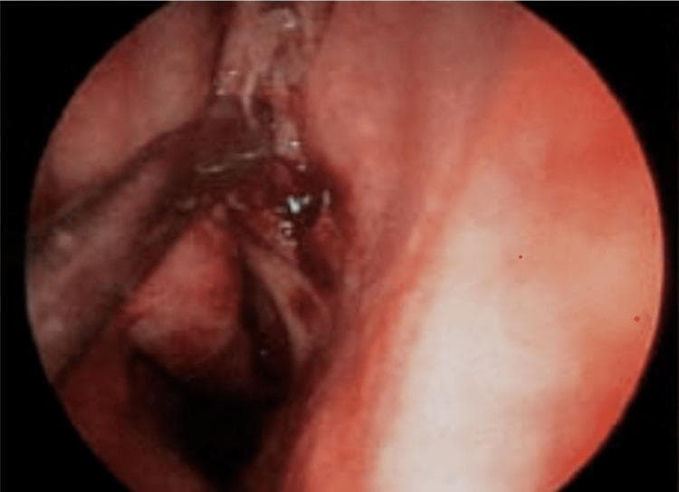 This diagnostic image is an intraoperative endoscopic view of the human nasal cavity during Functional Endoscopic Sinus Surgery (FESS). The visual field demonstrates the nasal septum and adjacent sinonasal mucosa, which exhibits a hyperemic, reddish-pink hue consistent with high vascularity or inflammatory response. Within the surgical field, thin metallic surgical instruments are visible, actively manipulating the tissue. There is evidence of dark red pooled blood and moist surfaces, characteristic of the intraoperative environment in sinus surgery. The image serves to illustrate the challenge of maintaining a clear surgical field in the presence of capillary bleeding and mucosal oozing. Key educational concepts include the visualization of endoscopic anatomy under surgical conditions and the importance of hemostasis for anatomical clarity during rhinological procedures.