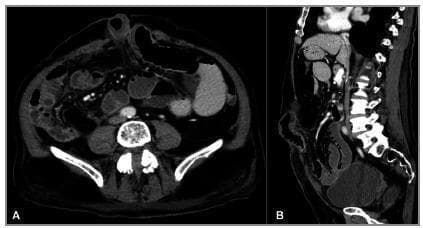 This diagnostic image consists of two panels (A: axial; B: sagittal) showing a contrast-enhanced computerized tomography (CT) scan of the abdomen and pelvis. The primary finding is a strangulated abdominal wall hernia. A small bowel loop is seen herniated through a midline abdominal wall defect. Key radiological features of strangulation and ischemia include significant parietal (wall) thickening of the incarcerated bowel loop, densification of the surrounding mesenteric fat (fat stranding), and the presence of localized fluid within the hernia sac. There is a perceptible reduction in contrast enhancement of the herniated segment compared to adjacent loops, indicative of vascular compromise. Proximal to the site of incarceration, multiple small bowel loops are dilated/distended, suggesting a secondary mechanical bowel obstruction. The images provide critical diagnostic evidence for acute surgical intervention in the context of complicated ventral hernias.