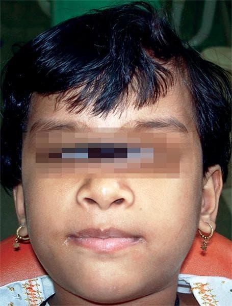 This clinical photograph shows the frontal facial view of a 6-year-old girl diagnosed with Glanzmann's thrombasthenia, a rare autosomal recessive bleeding disorder characterized by a defect in platelet aggregation. The patient exhibits a medium skin tone and short dark hair. While the eyes are obscured for patient anonymity, the visible facial features demonstrate a subtle, generalized puffiness. Clinically, the image serves to document the baseline physical appearance of a pediatric patient who presents with a significant medical history of spontaneous ecchymoses, easy bruising, and recurrent epistaxis. These manifestations are hallmark signs of the underlying qualitative platelet disorder involving the glycoprotein IIb/IIIa complex. In a dental context, identifying such patients is critical for pre-operative planning to prevent uncontrolled hemorrhage during procedures like extractions. The photograph highlights the importance of recognizing systemic hematological conditions in pediatric dentistry to ensure appropriate hematological consultation and hemostatic management.