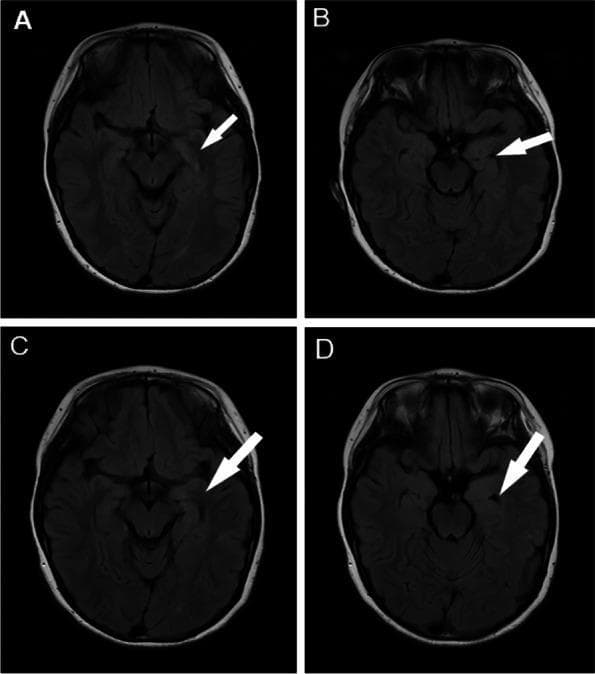 This Comparison Chart displays four axial brain MRI T2-weighted Fluid-Attenuated Inversion Recovery (FLAIR) images, labeled A through D, organized to show the progression of a pediatric patient with Anti-LGI1 autoimmune encephalitis before and after immunotherapy. Images A and B represent the pre-treatment baseline. Image A features a white arrow pointing to a localized area of hyperintensity in the left temporal pole, indicative of cortical/subcortical edema. Image B shows the associated compression of the temporal horn of the lateral ventricle. Images C and D represent the post-treatment state following intravenous immunoglobulin and corticosteroids. Image C demonstrates a slight reduction in the signal intensity and extent of the hyperintensity in the left temporal pole compared to Image A. Image D shows an enlarged left temporal horn (indicated by a white arrow) relative to Image B, signaling the resolution of local mass effect as the edema subsides. This clinical imaging series illustrates the radiological response of limbic encephalitis to immunosuppressive therapy.