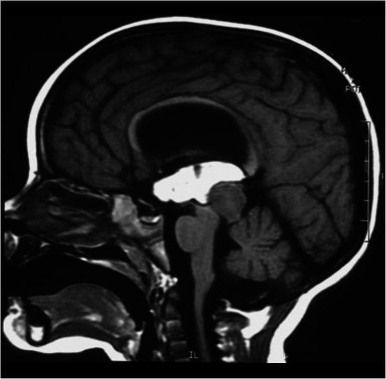 This diagnostic image is a sagittal T1-weighted MRI (or non-contrast CT) of the head, focusing on the midline brain structures. The most prominent finding is a large, irregularly shaped hyperintense region filling the third ventricle and extending into the lateral ventricles, consistent with acute intraventricular hemorrhage (IVH). A mass lesion is visible in the region of the quadrigeminal plate (tectal plate), representing a known pilocytic astrocytoma. The hemorrhage is a post-procedural complication following an endoscopic biopsy of this lesion. Significant ventriculomegaly is present, indicating obstructive hydrocephalus likely secondary to the combined mass effect of the tumor and the subsequent hemorrhage on the cerebral aqueduct. Anatomical landmarks clearly visible include the corpus callosum, midbrain, pons, medulla, and cerebellum. The hyperintense blood material creates a sharp contrast against the hypointense cerebrospinal fluid and isointense brain parenchyma. This image serves as a clinical illustration of acute complications in neuro-oncology and the resulting alterations in ventricular morphology.