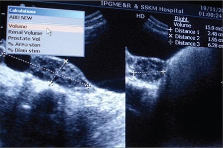 Diagnostic Image: This abdominal ultrasonography scan displays bilateral polycystic ovaries in a 13-year-old patient. The ultrasound reveals an enlarged right ovary with a measured volume of 15.9 cm³, which is significantly increased for the patient's age and pubertal status. Three linear distance measurements are visible on the screen: Distance 1 (2.48 cm), Distance 2 (1.95 cm), and Distance 3 (6.28 cm), used to calculate the ovarian volume and characterize a dominant cyst. Visually, the ovaries exhibit multiple small, peripherally located follicles and increased echogenic stroma, characteristic of polycystic ovarian morphology (PCOM). The clinical context involves a rare case of pediatric hyperinsulinemia and lipodystrophy, where severe insulin resistance leads to ovarian overstimulation and clitoromegaly. This image serves as a teaching tool for recognizing PCOM and understanding the impact of metabolic endocrine disorders on the reproductive system in prepubertal or early adolescent patients.