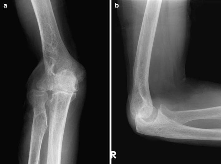 Two-view conventional radiographs of a human right elbow joint, including an anteroposterior (AP) view (a) and a lateral view (b), demonstrating post-surgical sequelae and secondary osteoarthritis. The AP view shows a widening or separation at the proximal radioulnar joint (PRUJ) and marked articular surface irregularity of the radiohumeral joint. The lateral view, taken in 90 degrees of flexion, reveals joint space narrowing and prominent anterior osteophyte formation on the distal humerus near the radiohumeral compartment. There is evidence of previous surgical intervention in the lateral epicondyle region of the humerus, leading to altered joint morphology. Findings are consistent with advanced degenerative changes following ligamentous instability and wide resection for an orthopedic tumor. Key educational features include the radiographic signs of secondary elbow osteoarthritis: subchondral sclerosis, osteophytosis, and joint space loss, particularly affecting the radiohumeral and ulnohumeral articulations.