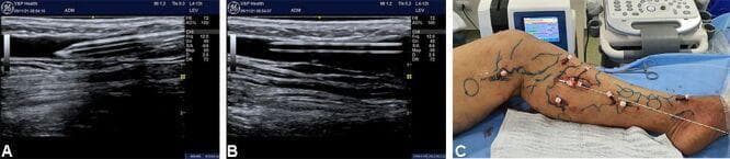 This composite figure illustrates a multi-puncture technique for the endovenous laser treatment of the great saphenous vein (GSV) and its tributaries. Panels A and B are longitudinal B-mode ultrasound images demonstrating ultrasound-guided cannulation. A No. 16 IV catheter appears as a linear, hyperechoic (bright) structure being advanced into the anechoic (dark) lumen of the target vein. The needle's trajectory and entry point are clearly visualized relative to the vessel wall. Panel C is a clinical photograph of a lower limb in a surgical setting. The skin is marked with blue topographical lines indicating the anatomical course of varicose tributaries and the GSV. Multiple percutaneous access points are visible along these markings, each equipped with a secured catheter hub (white/red). The limb is positioned on sterile blue drapes with medical equipment, including an ultrasound console and laser generator, visible in the background. This visual serves to educate on the perioperative steps of venous thermal ablation using a multiple-puncture access strategy.