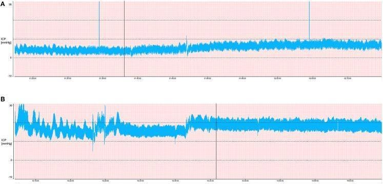 A comparison of two intracranial pressure (ICP) waveforms illustrating the visual differences between physiological and pathological pressure states. Panel A shows a normal ICP tracing with a mean pressure of approximately 5 mmHg. The signal is stable, exhibiting low pulse wave amplitude and high uniformity, reflecting normal intracranial compliance. Panel B displays a pathological ICP tracing at a mean pressure of 20 mmHg, a common clinical treatment threshold for intracranial hypertension. This waveform is characterized by increased pulsatility, higher pulse wave amplitude, and greater signal instability. The increased jaggedness and wider vertical oscillation in Panel B indicate reduced intracranial compliance. Both charts plot pressure in mmHg over time, set against a grid for quantitative assessment of mean levels and rhythmic fluctuations. These tracings are used in neuro-intensive care to identify abnormal pressure patterns such as Lundberg A or B waves and to guide treatment for traumatic brain injury (TBI) and other neurological conditions.