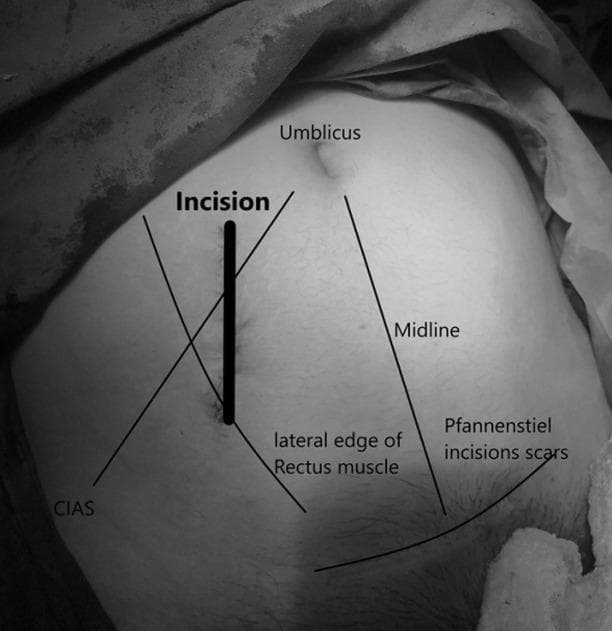This monochrome clinical photograph and procedural diagram illustrates a novel surgical approach for adnexal pathologies during pregnancy. The image shows a pregnant abdomen with a thick vertical line marking a mediolateral (near vertical) skin incision located in the right lower quadrant. Anatomical landmarks are labeled for orientation: the umbilicus is superior and medial to the incision; the abdominal midline is shown to the left of the incision; and the lateral edge of the rectus muscle is indicated. The incision is positioned approximately 3 cm lateral to the midline, near the lateral third of the rectus muscle. Additional landmarks include the Crista Iliaca Anterior Superior (CIAS) located inferiorly and laterally, and pre-existing Pfannenstiel incision scars in the suprapubic region. This surgical illustration is designed for obstetricians and surgeons to demonstrate a targeted paramedian laparotomy entry point that provides access to the adnexa while accommodating the displaced pregnant uterus, minimizing surgical trauma and avoiding previous scar tissue.