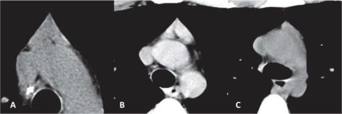 This diagnostic image contains three axial CT scan slices (labeled A, B, and C) demonstrating different morphological configurations of the thymus in the anterior mediastinum. (A) Displays an 'arrowhead' configuration where the two thymic lobes are confluent, forming a single triangular mass with soft-tissue attenuation similar to skeletal muscle. (B) Shows a 'bilobed' thymus presenting as two distinct, separate soft-tissue masses, appearing diffusely enlarged with density exceeding chest wall musculature. (C) Illustrates a single visualized lobe appearing as an asymmetrical soft-tissue mass. These imaging variants are critical in evaluating patients with myasthenia gravis, where thymic hyperplasia or thymoma may be present. The scans highlight essential anatomical relationships between the thymus and adjacent cardiovascular structures in the superior mediastinum, useful for differentiating normal thymic variants from pathology in adult patients.