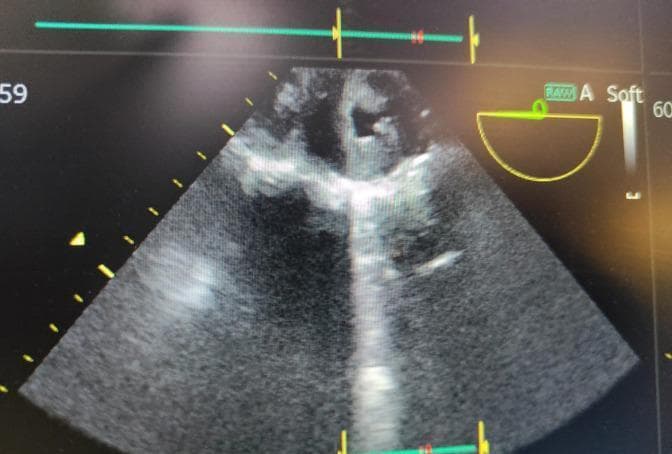 A 2-D transthoracic echocardiogram (TTE) in grayscale, demonstrating severe aortic valve stenosis. The image shows the aortic valve leaflets with significant thickening and increased echogenicity, indicating calcification or fibrosis. The valve orifice is markedly narrowed during systole. Distal to the stenotic valve, there is a region of speckled, high-amplitude echoes suggesting turbulent blood flow and mild aortic regurgitation. The echocardiographic view captures the cardiac anatomy in a sector format, with depth markers along the left margin and an electrocardiogram (ECG) trace at the top for cardiac cycle synchronization. This diagnostic image illustrates key hemodynamic changes associated with valvular heart disease, suitable for teaching aortic valve pathology and the assessment of stenotic severity in a clinical setting.