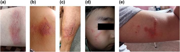 This composite of clinical photographs illustrates various cutaneous manifestations of Paederus dermatitis across different anatomical regions. Image (a) shows an irregularly shaped erythematovesicular patch on the anterior forearm, characterized by tiny clustered vesicles on an inflammatory base. Image (b) displays a localized lesion on the back featuring a central ruptured blister with peripheral erythema. Images (c), (d), and (e) demonstrate the classic linear dermatitis pattern (dermatitis linearis). Specifically, (c) shows a longitudinal inflammatory streak on the lateral leg with evidence of crusting; (d) shows thin, linear erythematous tracks on the right malar region of the face; and (e) displays a linear arrangement of vesicles and erythema on the arm. These patterns are pathognomonic for irritant contact dermatitis caused by pederin release from rove beetles (Paederus species), typically occurring when the beetle is crushed against the skin, resulting in linear transfer of the toxin. The images emphasize the morphological variety, ranging from localized bullae to streaky, whip-like inflammatory lesions.