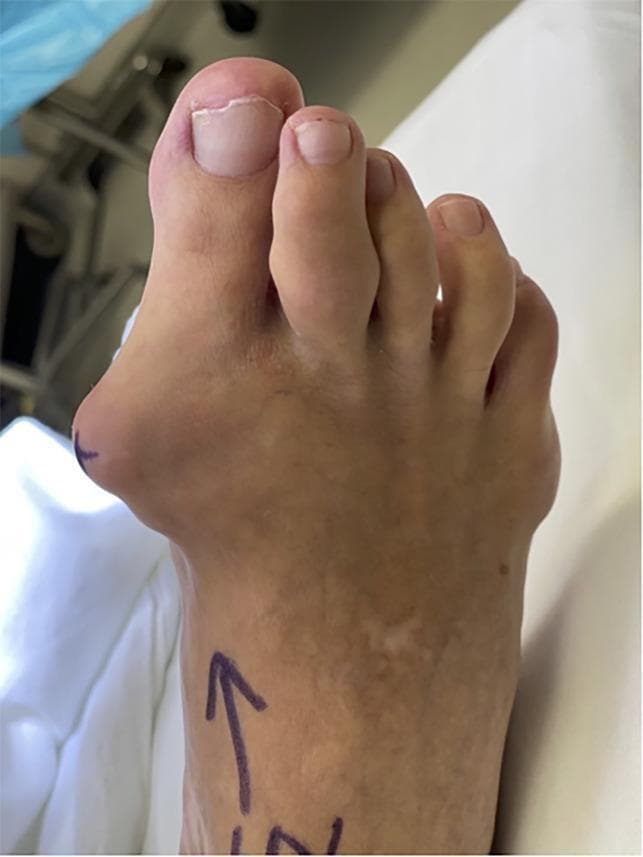 This clinical photograph displays a human right foot from a dorsal-medial perspective, illustrating advanced manifestations of chronic tophaceous gout and associated forefoot deformities. A large, prominent gouty tophus is visible as a firm, bulging subcutaneous mass on the medial aspect of the first metatarsophalangeal (MTP) joint. This mass creates a significant clinical hallux valgus deformity, characterized by the lateral deviation of the great toe toward the second digit. Additionally, the second toe exhibits soft tissue swelling and a smaller tophaceous deposit at the level of the proximal interphalangeal joint, resulting in a visible deformity. The skin over the primary tophus appears stretched and thin, though no ulceration is present. Surgical markings (an arrow) are visible on the dorsal surface of the foot, indicating preoperative preparation. The image serves as a clinical example of how monosodium urate crystal deposition can lead to significant structural joint distortion and secondary mechanical deformities in the foot.
