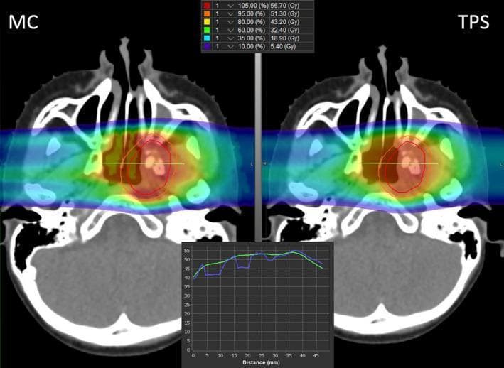This Comparison Chart displays an axial CT slice of a pediatric patient's skull, specifically the infratemporal fossa, used for radiation therapy planning. The image is split into two comparative halves: 'MC' (Monte Carlo calculation) on the left and 'TPS' (Treatment Planning System calculation) on the right. Both halves feature a color wash dose distribution map overlaid on the anatomy, ranging from blue (10% / 5.40 Gy) to red (105% / 56.70 Gy). Visible anatomical structures include the ethmoid sinus, nasal cavity, and brain. Two specific contours are delineated within the dose field: the Gross Tumor Volume (GTV) in red and the Clinical Target Volume (CTV) in orange. The visualization highlights dose variations around high-heterogeneity areas like the bone-air interface of the sinuses. At the bottom, an inset line graph plots a dose profile (Distance in mm vs. Dose in Gy), with a blue line representing the MC data and a green line representing the TPS data, illustrating subtle discrepancies between the two calculation models. This comparison is clinically significant for validating treatment accuracy in proton therapy for Ewing sarcoma.