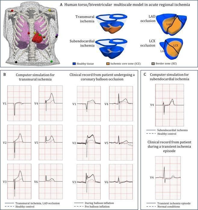 This infographic and diagnostic diagram illustrates a human torso and biventricular electrophysiology model for simulating acute regional myocardial ischemia and its effects on ECG signals. Panel A displays a 3D mesh torso model with standard 12-lead ECG electrode placements and cross-sectional schematic representations of the heart. These schematics distinguish between transmural ischemia (affecting the full thickness of the myocardium) and subendocardial ischemia (confined to the inner layer), highlighting the Ischemic Core Zone (ICZ) and Border Zone (BZ) in relation to LAD and LCX coronary artery occlusions. Panel B provides a side-by-side comparison of computer-simulated ECG signals and clinical recordings from a patient with LAD occlusion, demonstrating characteristic ST-segment elevation in precordial leads V1-V6 during transmural ischemia. Panel C compares simulated and clinical ECG data for subendocardial ischemia, focusing on lead V4 to show characteristic ST-segment depression. This resource serves as an educational tool for understanding the electrophysiological correlation between the depth of myocardial injury and surface ECG manifestations.